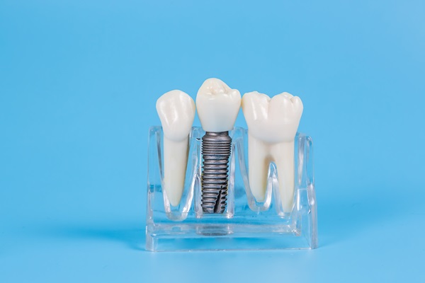 Are There Age Restrictions For Dental Implants?